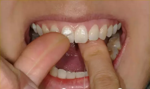 牙线怎么使用