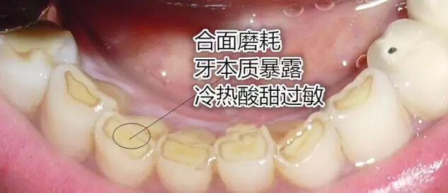 夜磨牙的危害